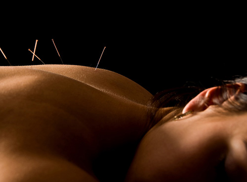 acupuncture Meher Clinic